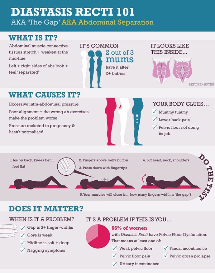 Diastasis101Web